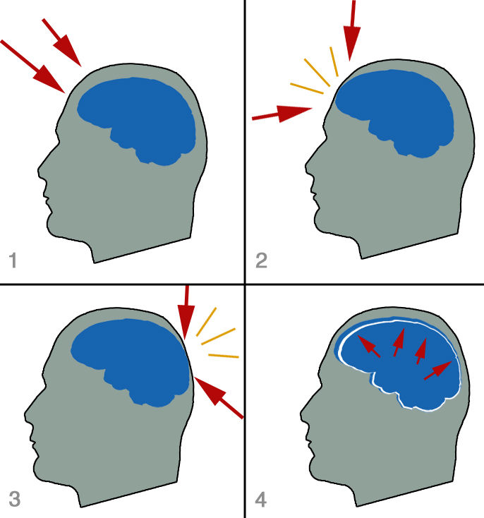Concussion stages
